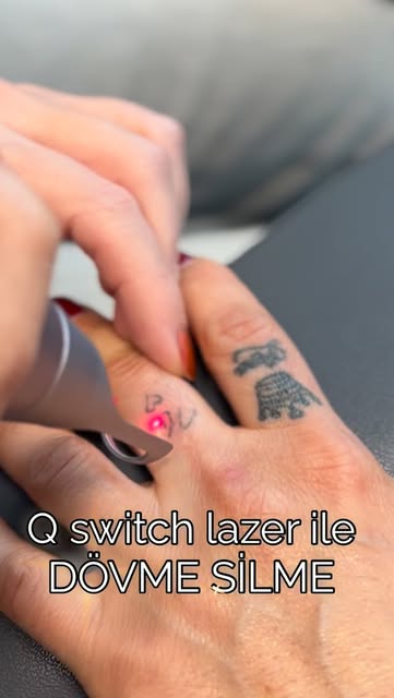 Q Switch lazer uygulaması